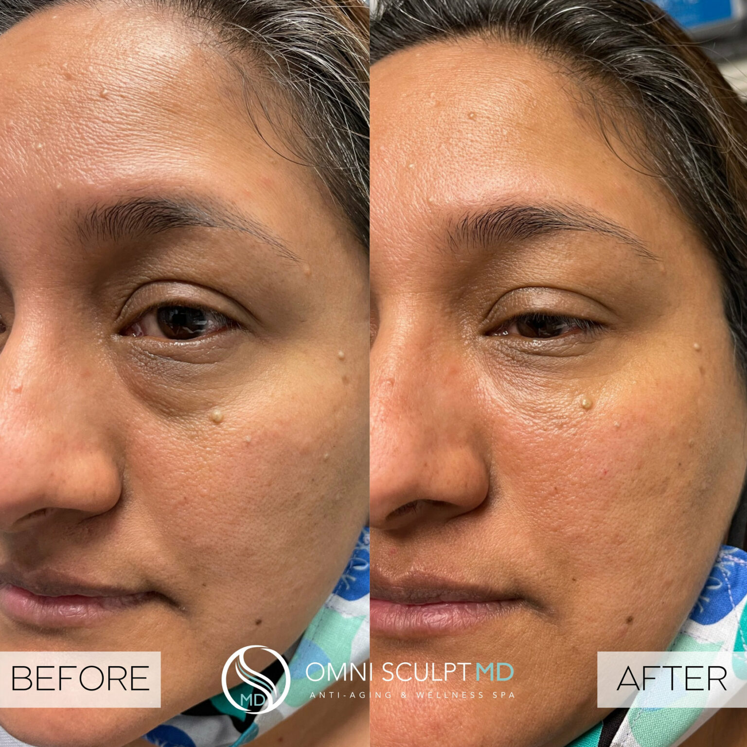 Facial Filler Before After Gallery Omni Sculpt Md