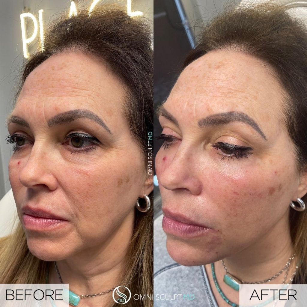 Chin And Jawline Filler In Dallas TX OMNI SCULPT MD