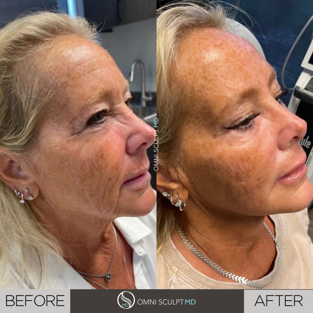 Facial Filler Before After Gallery OMNI SCULPT MD