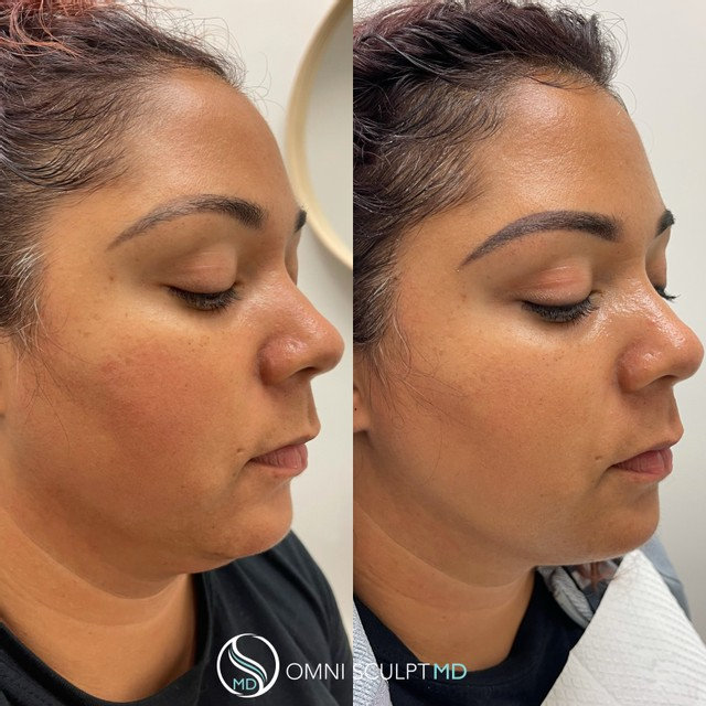 View Our Kybella Before & After Gallery