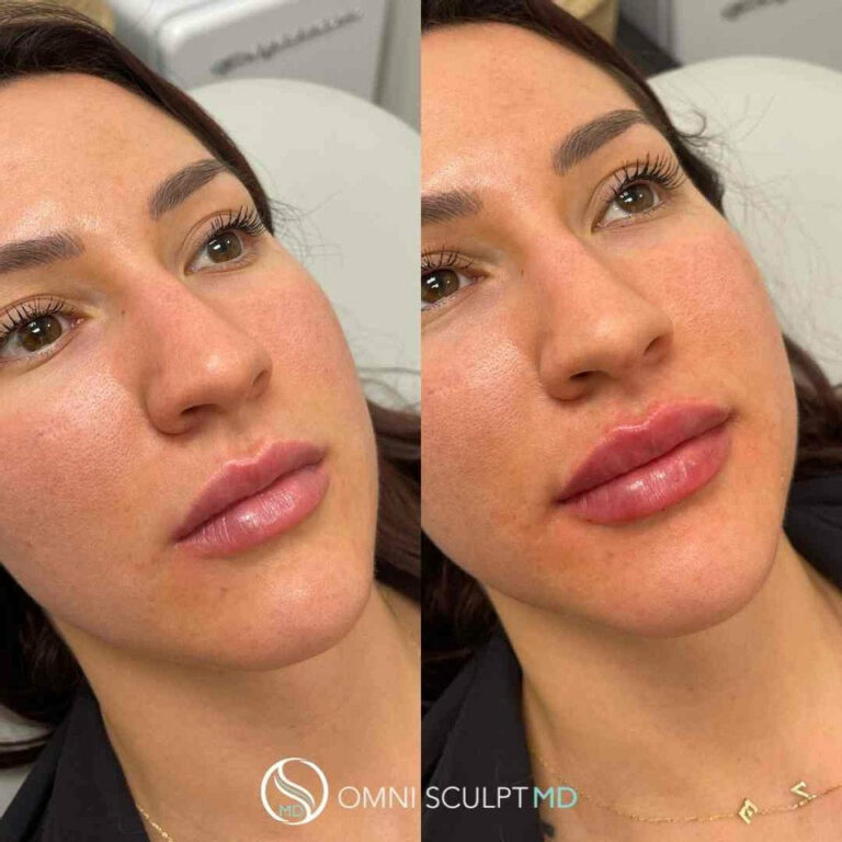 Lip Injection Before And After Gallery Omni Sculpt Md