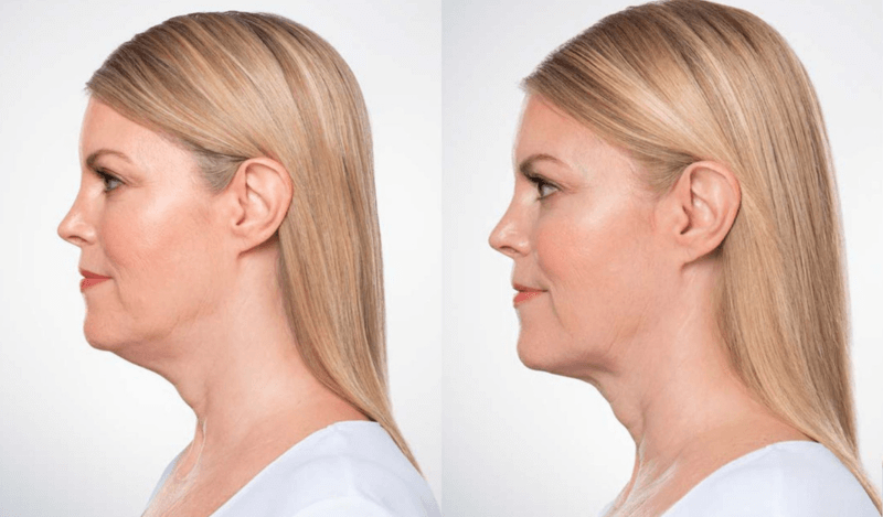 Kybella injections