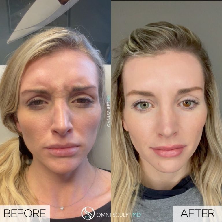 View Our BOTOX® Before & After Gallery | OMNI SCULPT MD