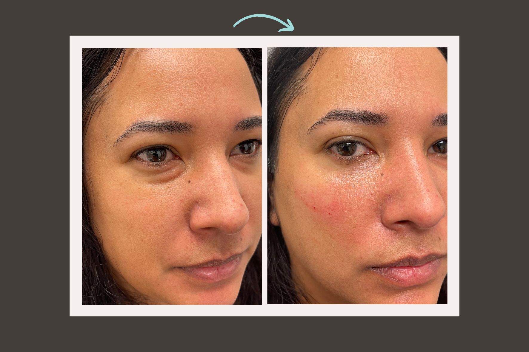 Gallery Series Under Eye Filler Before and After